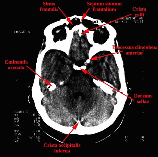 tomografia komputerowa głowy - 05a.jpg